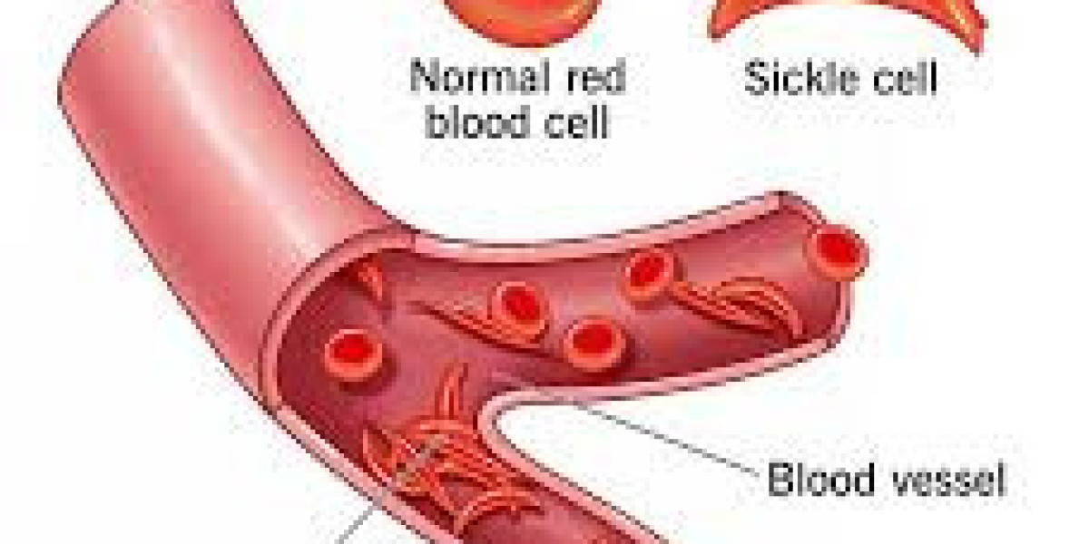 Understanding Sickle Cell Anemia: A Genetic Blood Disorder